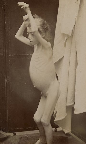 File:Girl with tuberculosis of the joints Wellcome L0061358.jpg