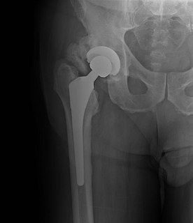 Heterotopic ossification development of bony substance in normally soft structures