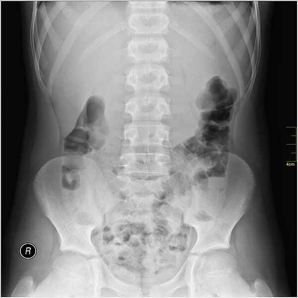 File:Medical X-Ray imaging QWK06 nevit.jpg