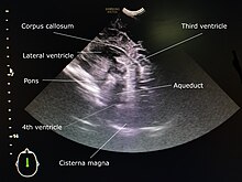 Mid sagittal section through anterior fontanelle of a one-year-old girl. Mid saggital section of ultrasound cranium.jpg