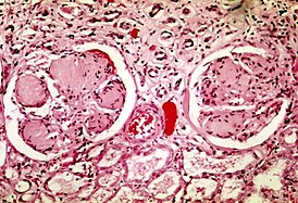 Mikrovalokuva nodulaarisesta glomeruloskleroosista Kimmelstiel-Wilsonin oireyhtymässä.