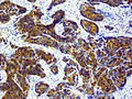 Metastaza kostiju i mekog tkiva u karcinomu prostate sa imunohistohemijskim dokazima PSA ekspresije (braon)