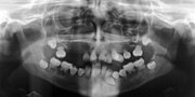 صورة مصغرة لـ خلل التنسج في عاج الأسنان