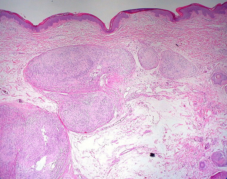 File:Plexiform Schwannoma 2.jpg