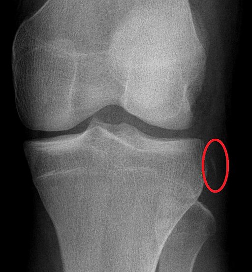 SegondFracture