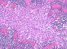 Sinus histiocytosis, a common feature in lymph node biopsies, is characterized by dilated sinuses containing variable numbers of histiocytes. Sinus histiocytosis (intermediate magnification).jpg