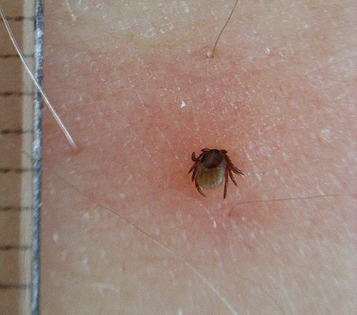 Tick bite, redness, tick, Lyme disease