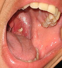 https://upload.wikimedia.org/wikipedia/commons/thumb/b/b9/Tonsillolith_in_mouth.jpg/211px-Tonsillolith_in_mouth.jpg