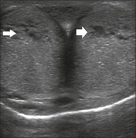 Transverse ultrasound image, ventral view of the penis. Image obtained after induction of an erection, 15 min after injection of prostaglandin E1, showing dilated sinusoids (arrows).[35]