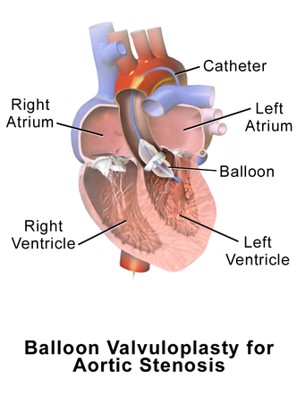 Balloon aortic valvuloplasty Valvuloplasty Aortic.png