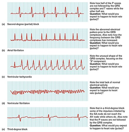 Arrhythmia Simple English Wikipedia The Free Encyclopedia