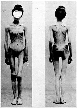 Anorexia Nervosa: Geschiedenis, Ziektebeeld, Behandeling