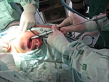 Photographie d'un homme endormi entouré de deux médecins habillés stérilement, avec un bronchoscope introduit dans la bouche.