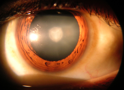 Cataract surgery is mentioned in the Sushruta Samhita, to be performed with a jabamukhi salaka, a curved needle used to loosen and remove the obstructing phlegm, with eye soaked with warm butter and bandaged afterward.[157]