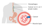 Thumbnail for File:Diagram showing stage 2B oesophageal cancer CRUK 488.svg