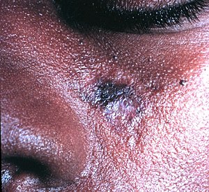 Discoid lupus erythematosus.JPG