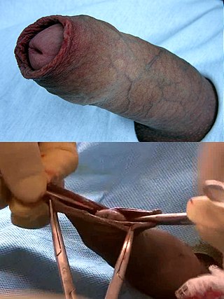 <span class="mw-page-title-main">Dorsal slit</span> Incision on penis foreskin expoing the glans