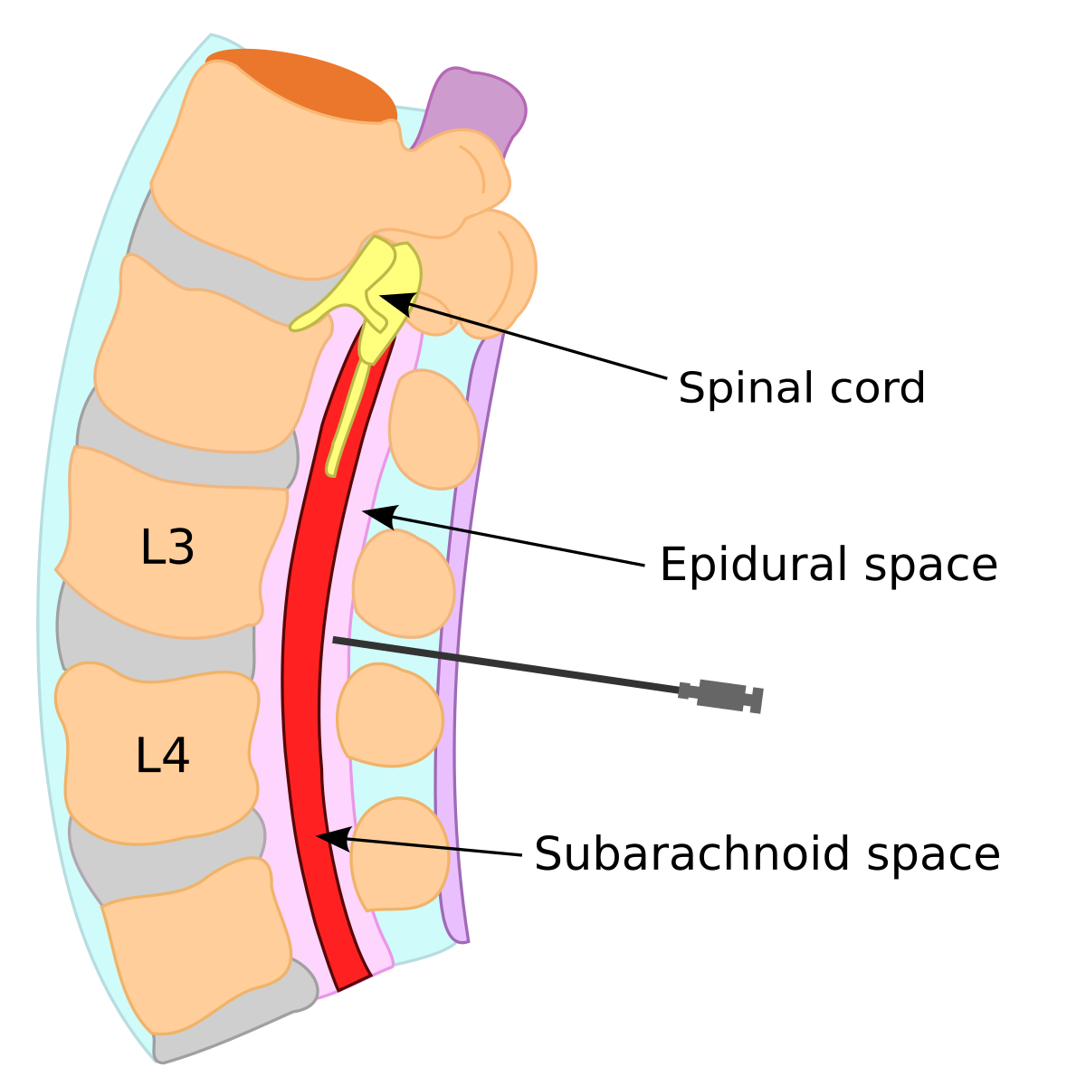 Epidural blood patch - Wikipedia