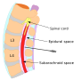 Thumbnail for Epidural blood patch