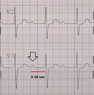 First-degree atrioventricular block Medical condition