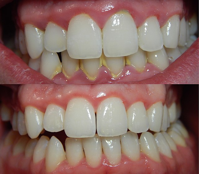 Top: typical presentation of gingivitis. Bottom: healthy gingiva.