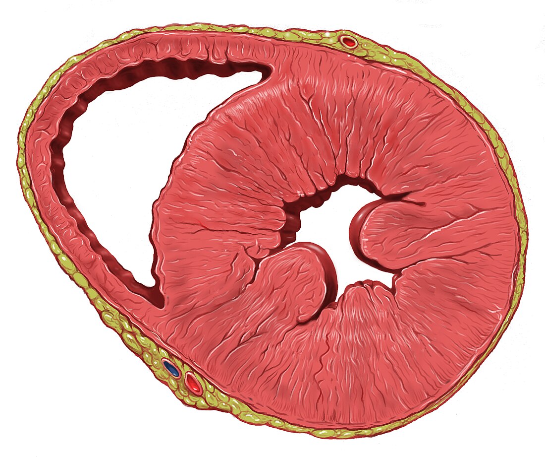 Left ventricular hypertrophy