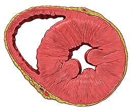 Descripción de la imagen Hipertrofia del ventrículo izquierdo del corazón sa.jpg.