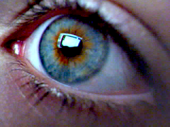 heterochromia sectoral heterochromie iridum wikimedia