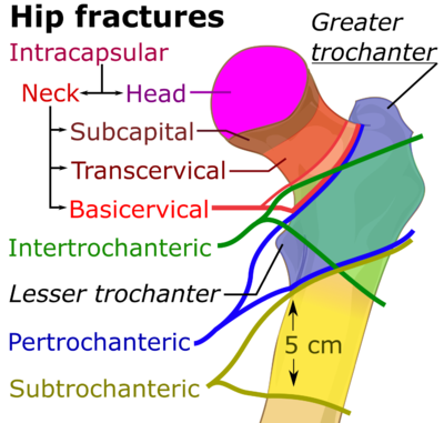 Hip fracture classification.png