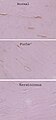 Keratoconus keratocytes alcohol dehydrogenase 3.jpg