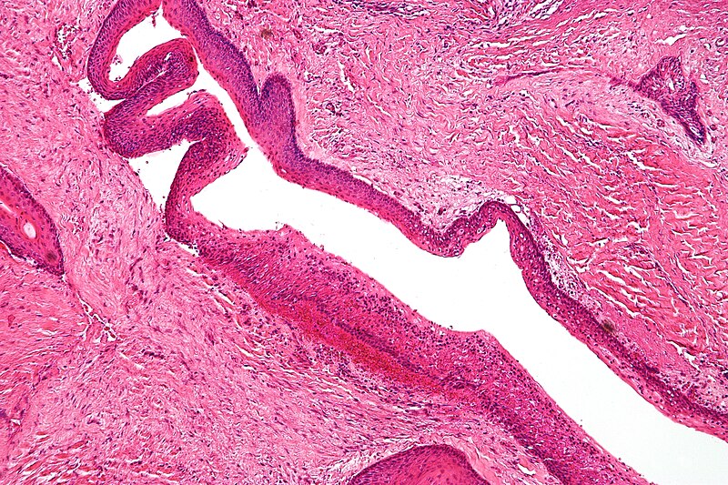 File:Keratocystic odontogenic tumour - intermed mag.jpg