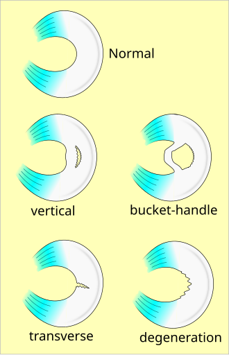 Types of meniscus tears Meniscus tear types.svg