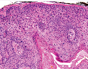 Micrograph of squamous cell carcinoma in situ - 100x.jpg