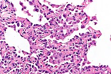 Micrograph showing multifocal micronodular pneumocyte hyperplasia. H&E stain. Multifocal micronodular pneumocyte hyperplasia - tuberous sclerosis - a3 -- high mag.jpg