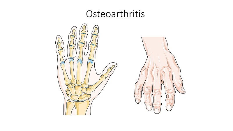 File:Osteoarthritis -- Smart-Servier.jpg