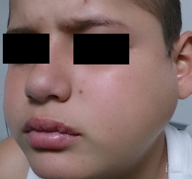 File:Parotiditis (Parotitis; Mumps).JPG