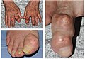 Tophaceous gout.jpg
