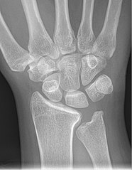 Negative ulnar variance.