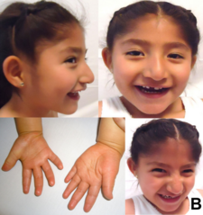pětiletá dívka z Mexika s Angelmanovým syndromem
