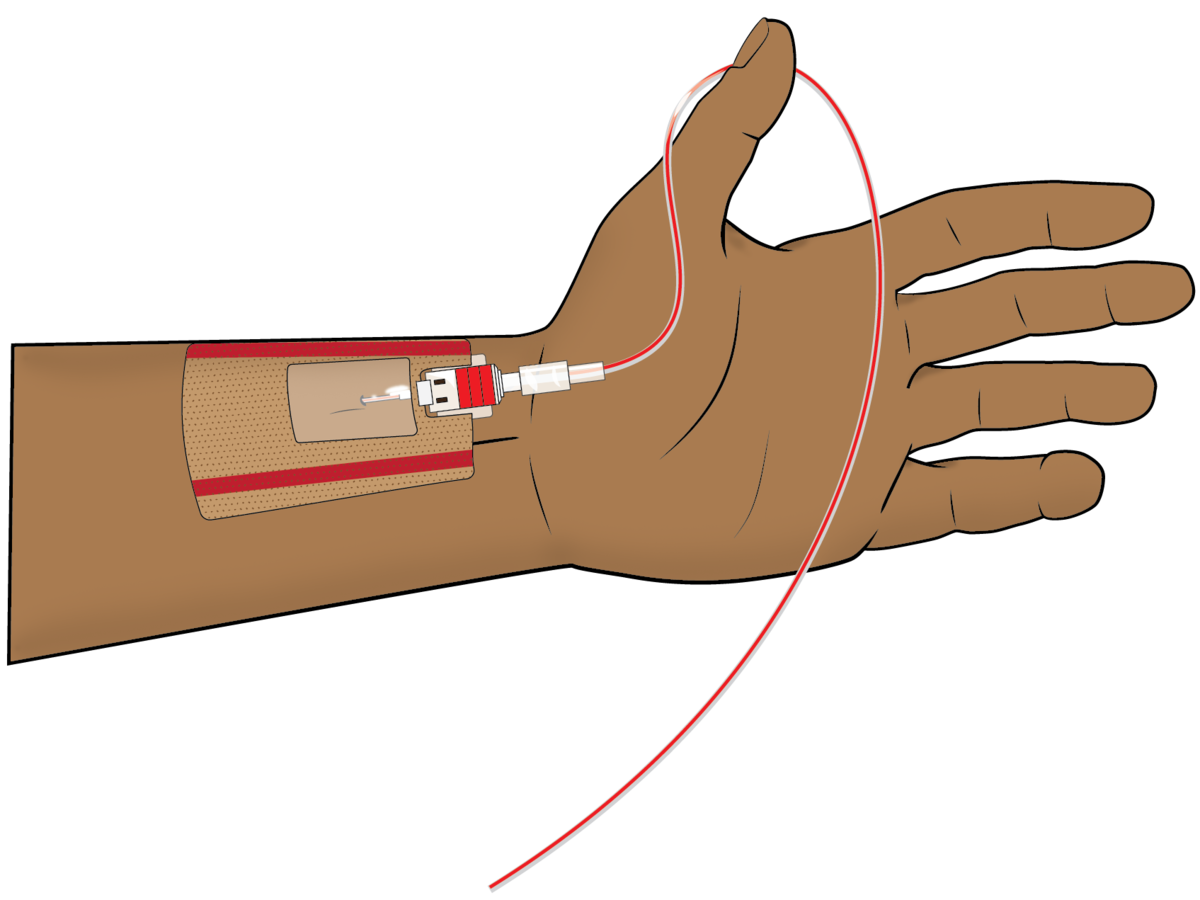 arterial line set up