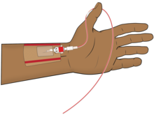 Illustration of an arterial catheter inserted in the left radial artery and covered with a dressing Arterial-line-shaded.png