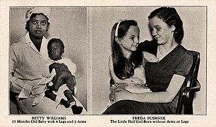 Betty Williams, 15 Months Old Baby With 4 Legs And 3 Arms; Freda Pushnik, The Little Half Girl... (NBY 415670).jpg