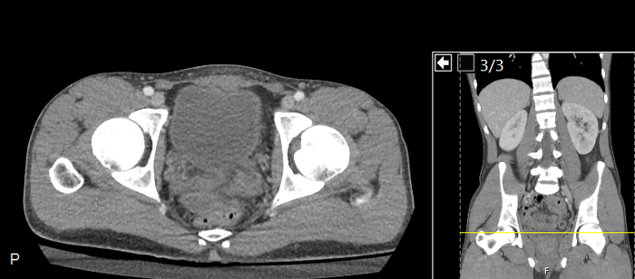 CT of a normal abdomen and pelvis, axial plane 253.png