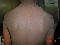 Familial acanthosis nigricans2.jpg