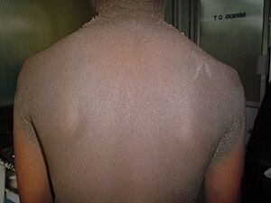 Familial acanthosis nigricans2.jpg