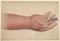 Hand with cellulitis following upon a poisoned wound Wellcome L0062185.jpg