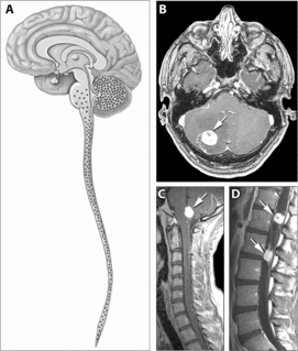 Von Hippel–Lindau disease Medical condition