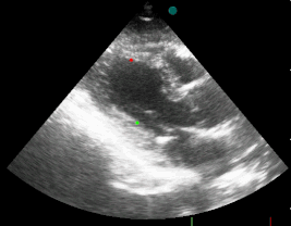 Echokardiografický obraz infarktu prednej steny ľavej komory