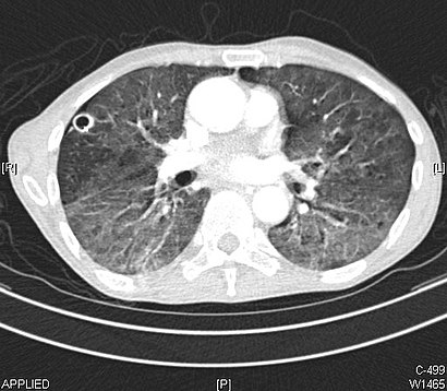 how do you get tested for emphysema