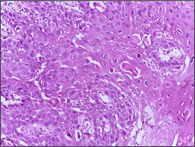 File:Squamous cell carcinoma skin, Well differentiated 40X.jpg